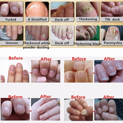 Fungal Nail Oil Treatment
